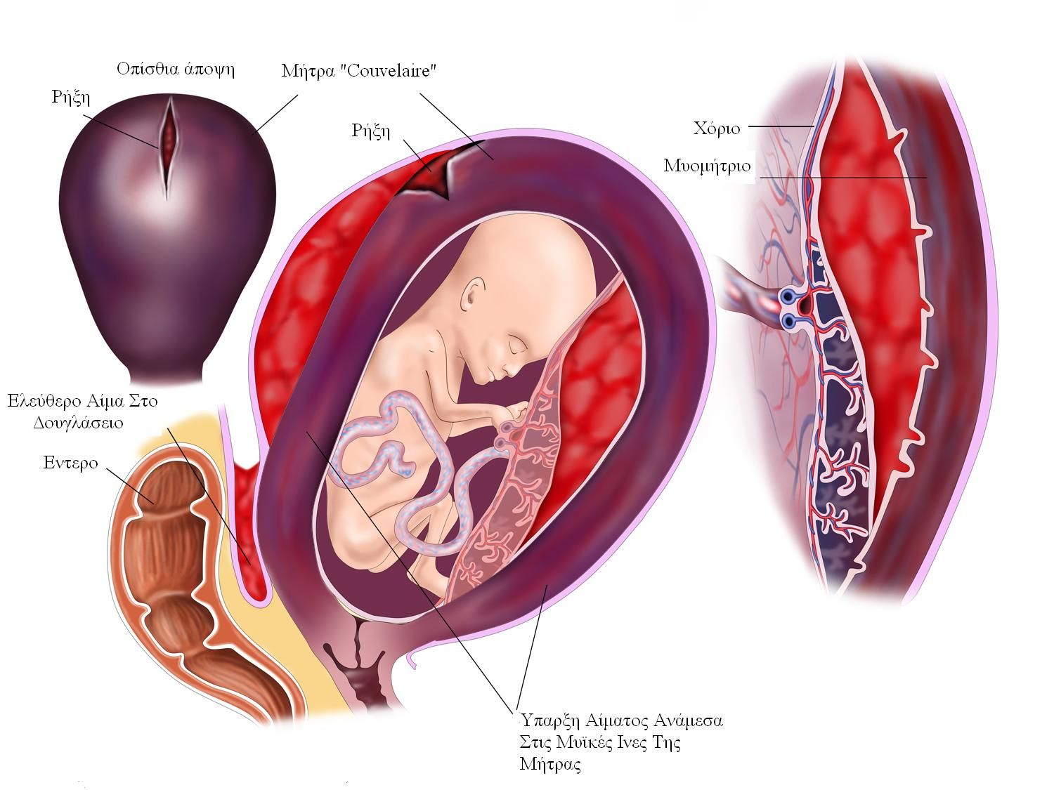 Плацента матка отслойка